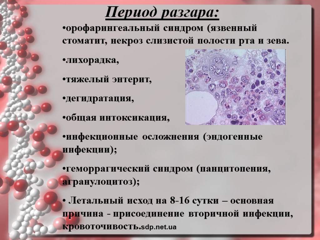 Период разгара: орофарингеальный синдром (язвенный стоматит, некроз слизистой полости рта и зева. лихорадка, тяжелый